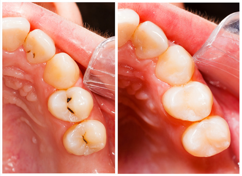 Fillings St. Petersburg, FL