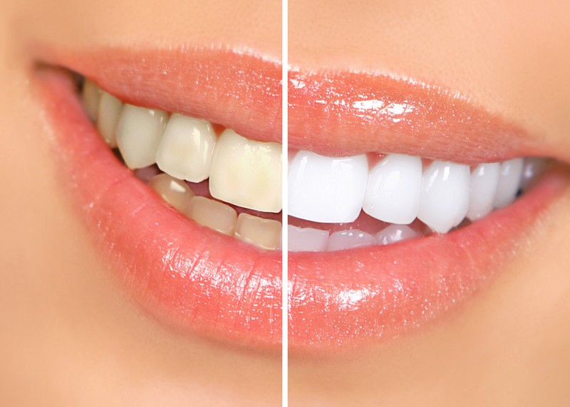 Teeth Whitening St. Petersburg, FL